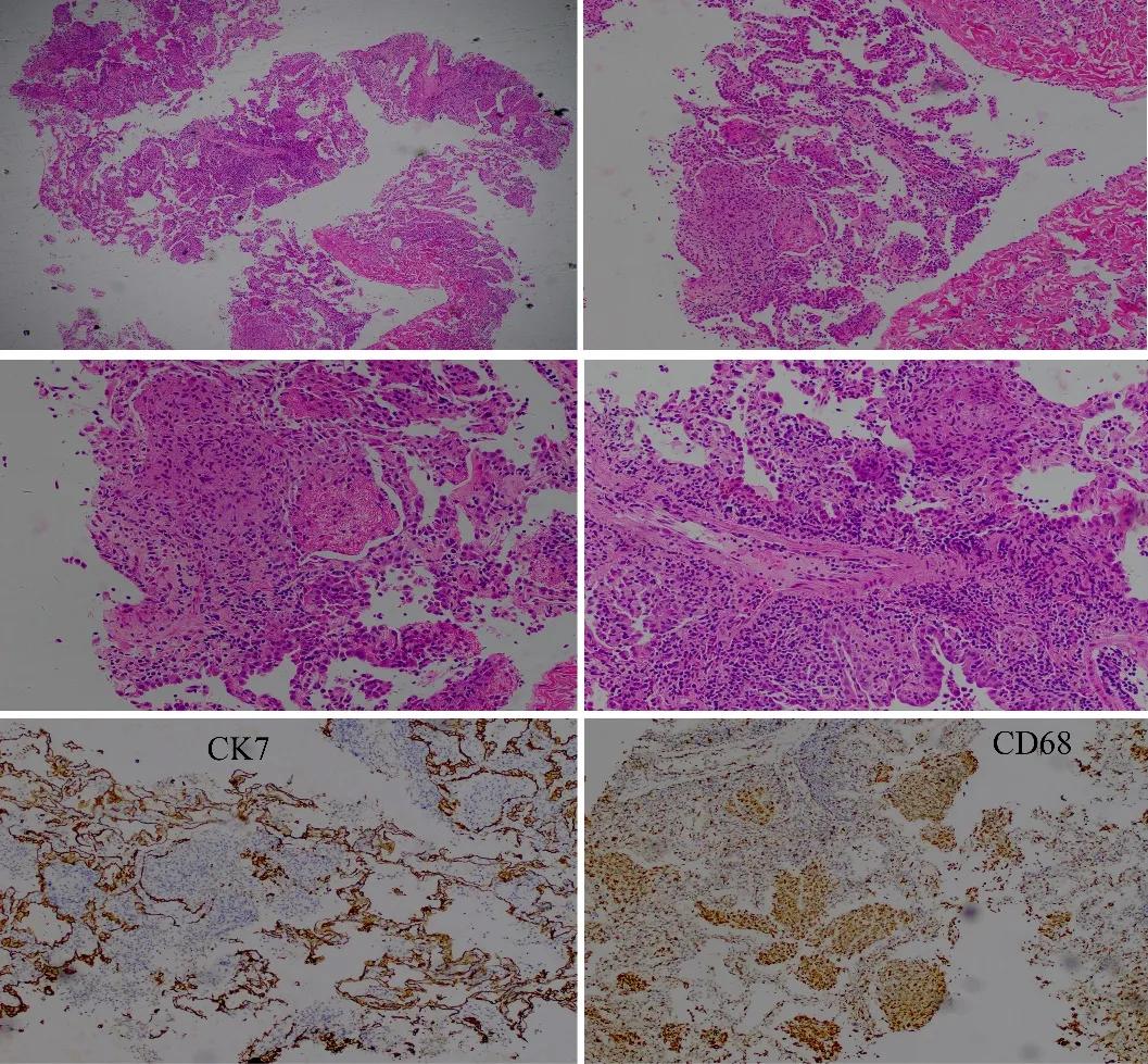 特发性肺炎一直用激素治疗,机化性肺炎住院治疗使用什么药物