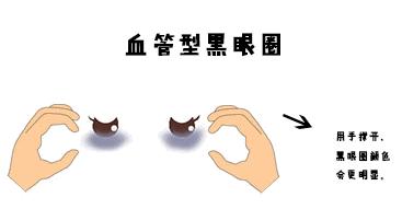 没有熬夜也有黑眼圈怎么办,没有熬夜黑眼圈怎么去除