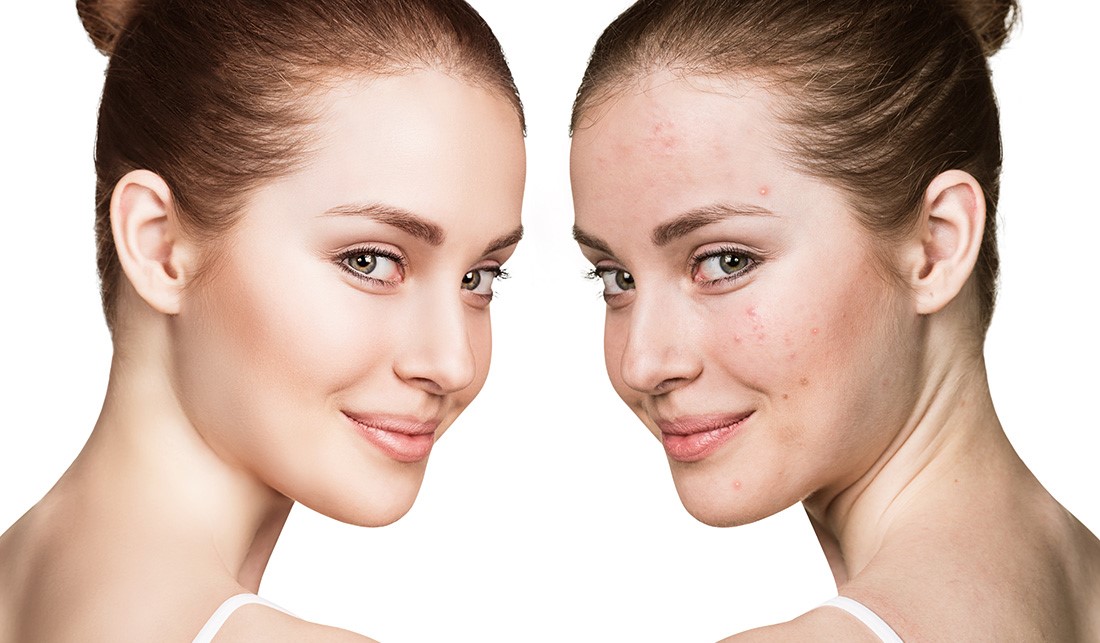 痘博士19.9元全国体验套餐,痘博士18.8元祛痘体验