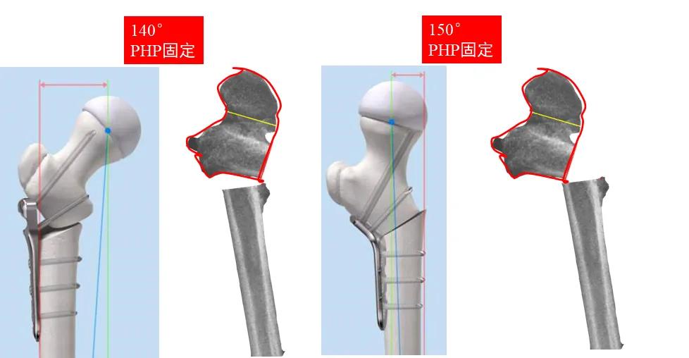 小儿先天性髋内翻名词解释,小孩走路颠足内翻