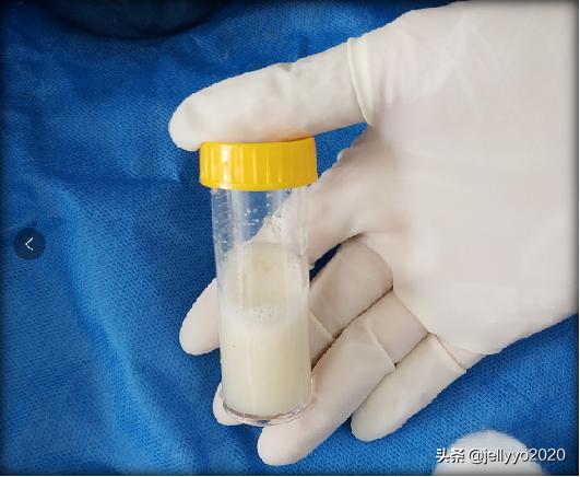 支气管镜灌洗和肺泡灌洗一样吗,支气管肺泡灌洗术示意图