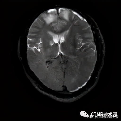 「MRI技术」磁共振伪影分析，了解下SSh_FLAIR序列