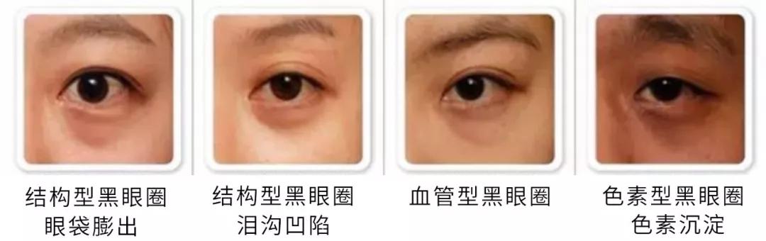 黑眼圈，今天就来消灭你