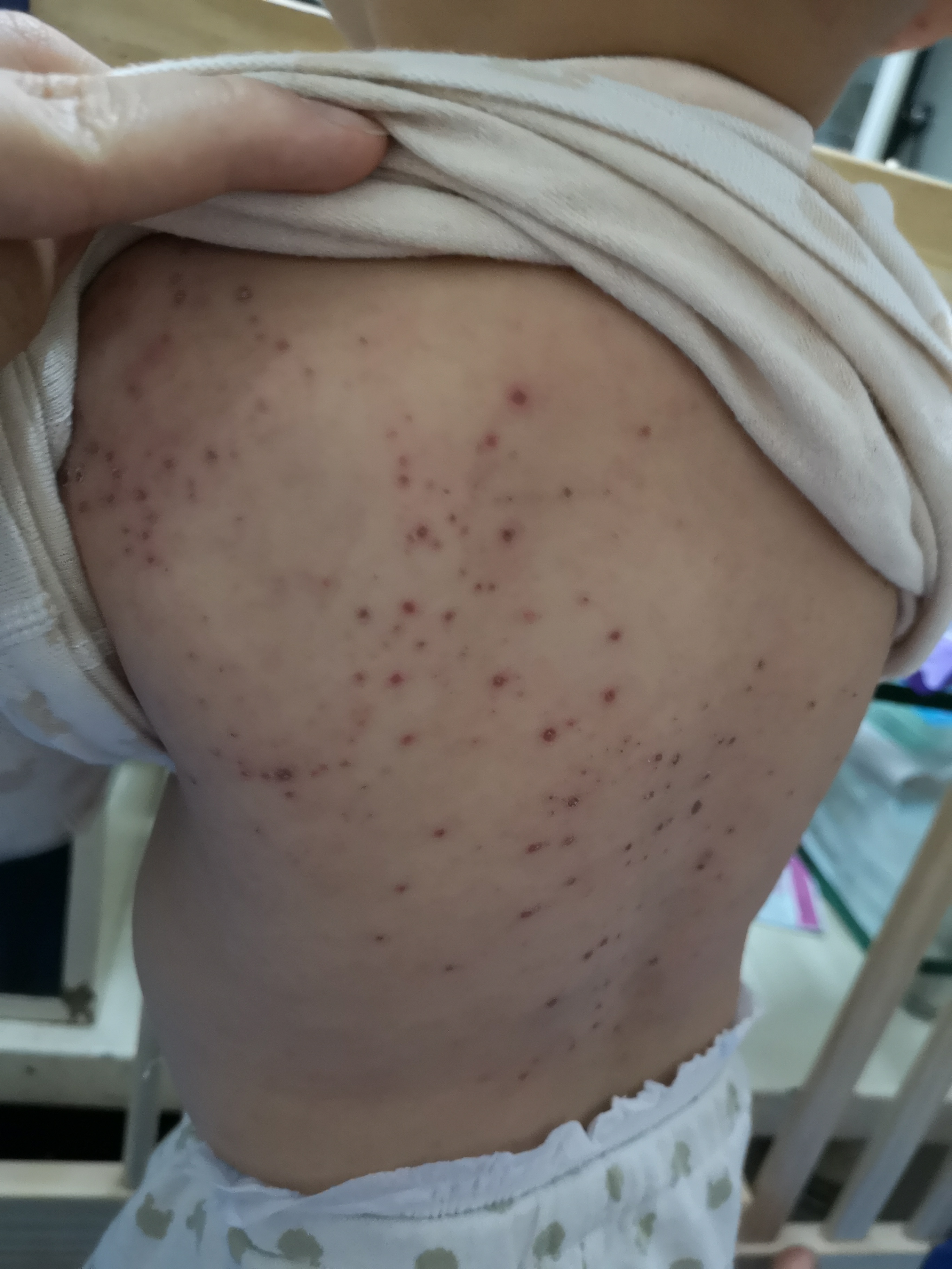 手足口病毒高发期,手足口高发期温馨提示