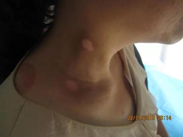 从确诊到康复，仅4个月，颈部白癜风患者王女士分享成功经验