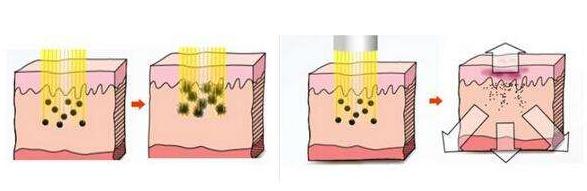 产妇脸上干燥起皮有红点怎么办,生完孩子脸上有褐斑怎么消除