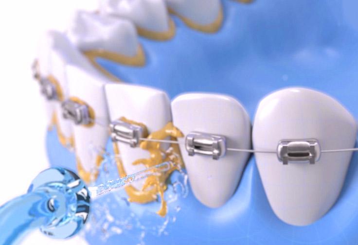 去口臭清洁口腔牙渍,口臭牙臭去除神器