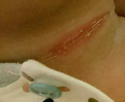 宝宝淹脖子推荐什么爽身粉,宝宝淹脖子爽身粉