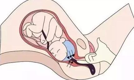 什么是脐带脱垂如何处理,臀位宝宝脐带脱垂有什么感觉