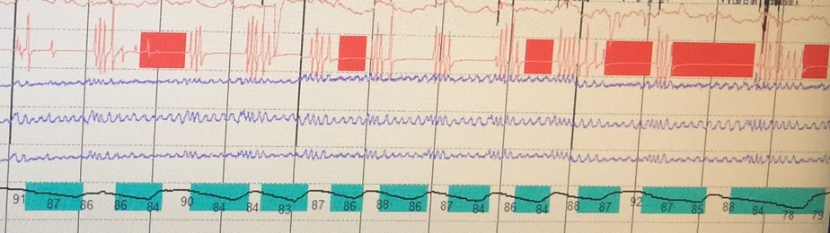 睡觉打呼噜憋住了,打呼噜把自己憋醒对身体有伤害吗