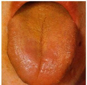 中医看舌头知病情图片,看舌头知病情图解大全