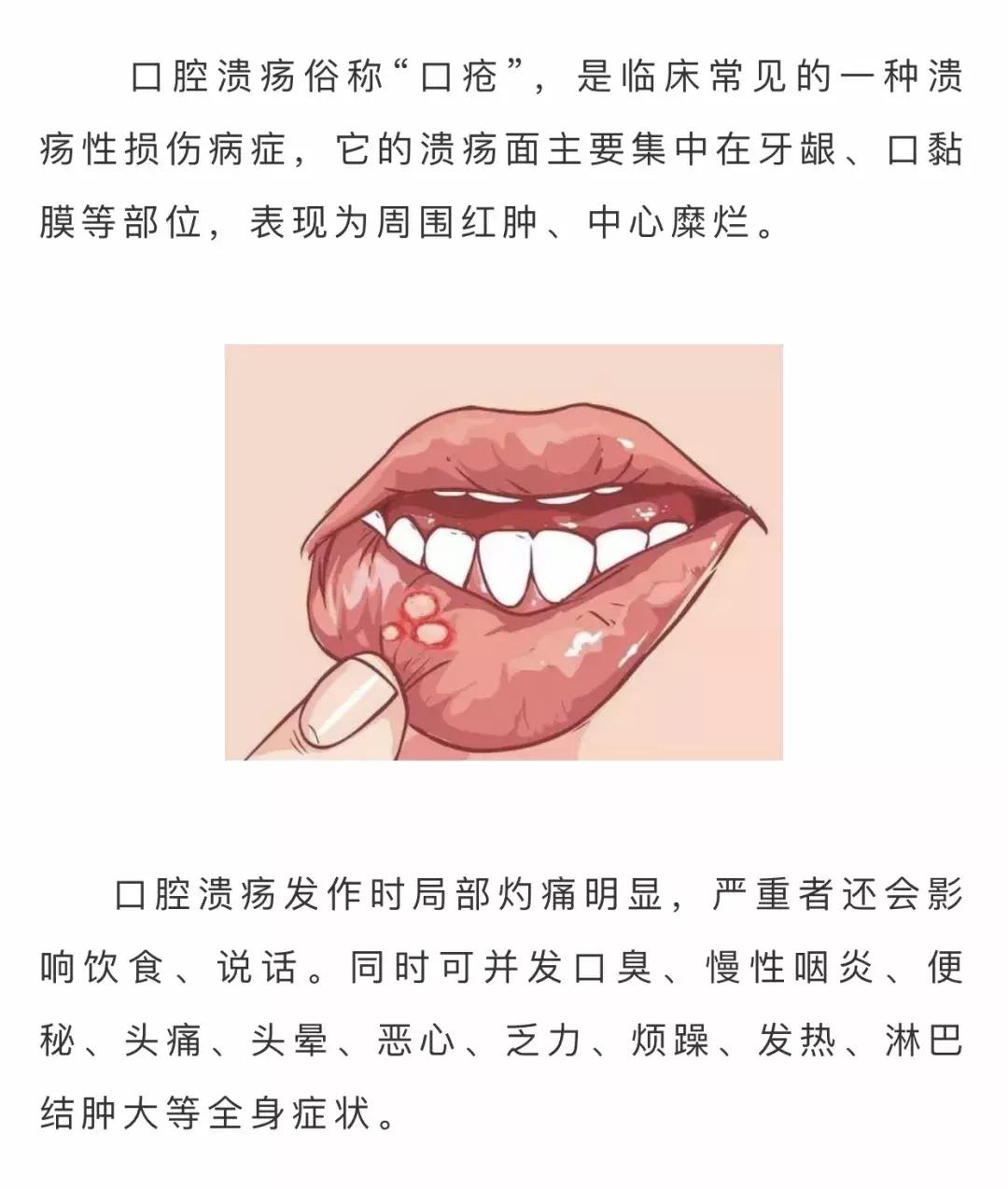 口腔溃疡推荐用碘甘油,碘甘油治口腔溃疡怎么样
