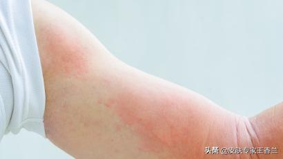 麻疹初期会出现皮肤痒吗,麻疹是不是有痒有疼