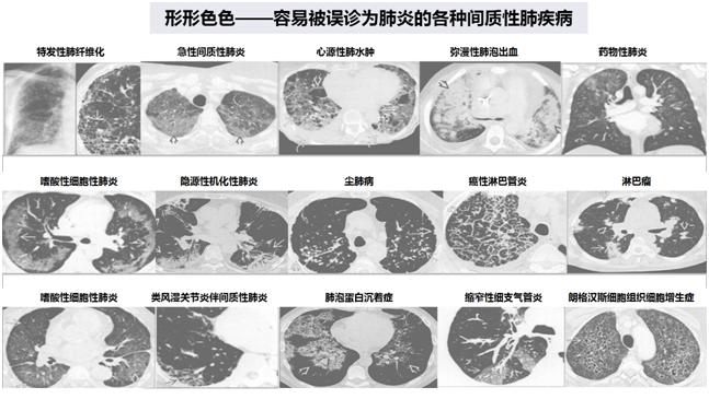 间质性肺病是啥,间质性肺病是什么病严重吗