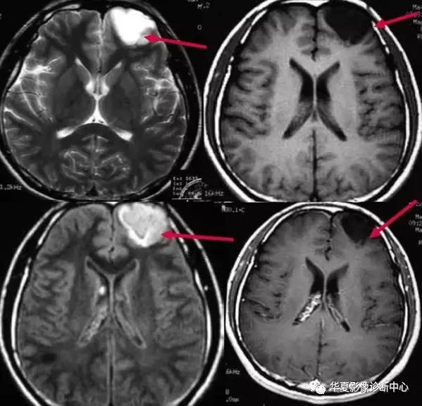 颅脑核磁影像解剖图谱,颅脑mr增强影像图片