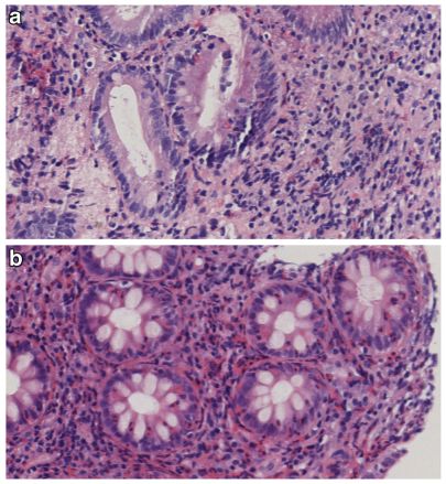 嗜酸粒细胞性胃肠炎吃哪些菜最好,嗜酸性粒细胞胃肠炎有什么反应