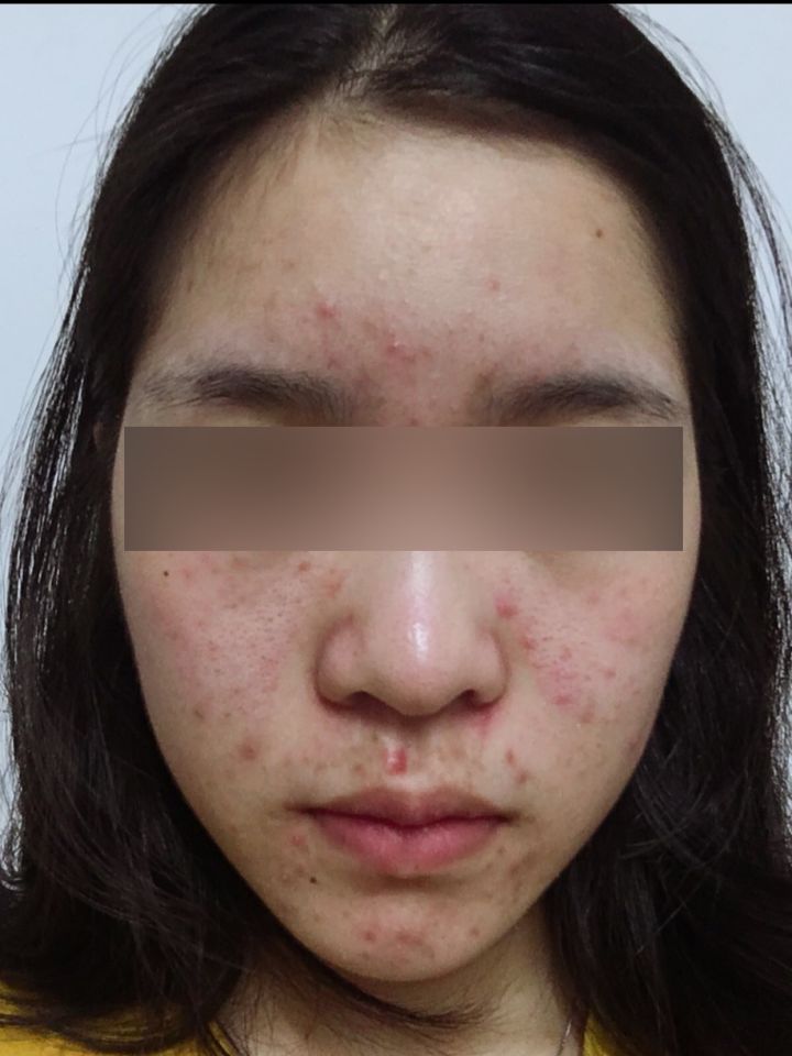 你们的痘痘最后都是怎么完全好的？反正我是用了这个方法才好的