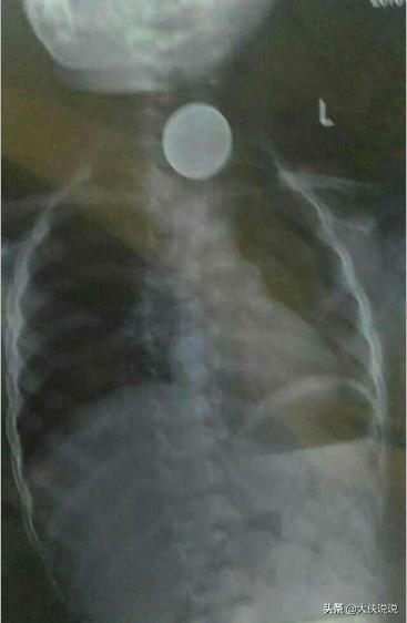 小孩吞入异物一般掉落到哪儿,吞入异物自救法