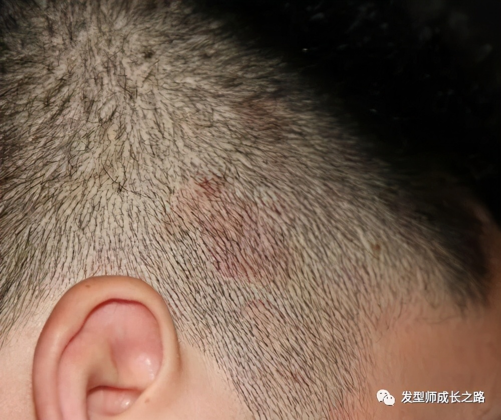 头皮屑的真正原因,头皮屑基础了解