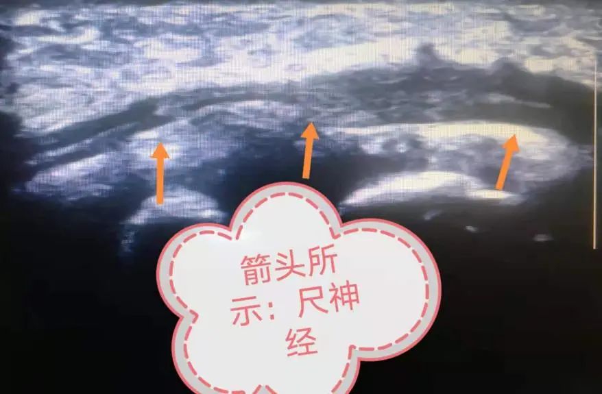 手麻肌电图检查过程视频,手麻脚麻肌电图正常