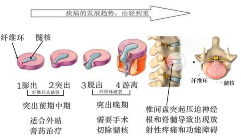 不用手术治疗腰椎间盘突出症？看中医张建福如何帮你摆脱痛苦