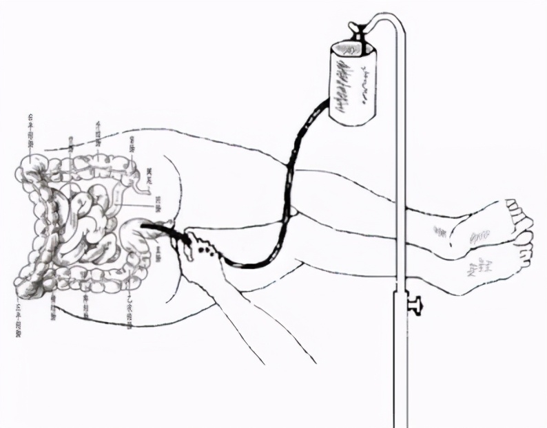 咖啡灌肠是不是保留灌肠,咖啡灌肠疗法