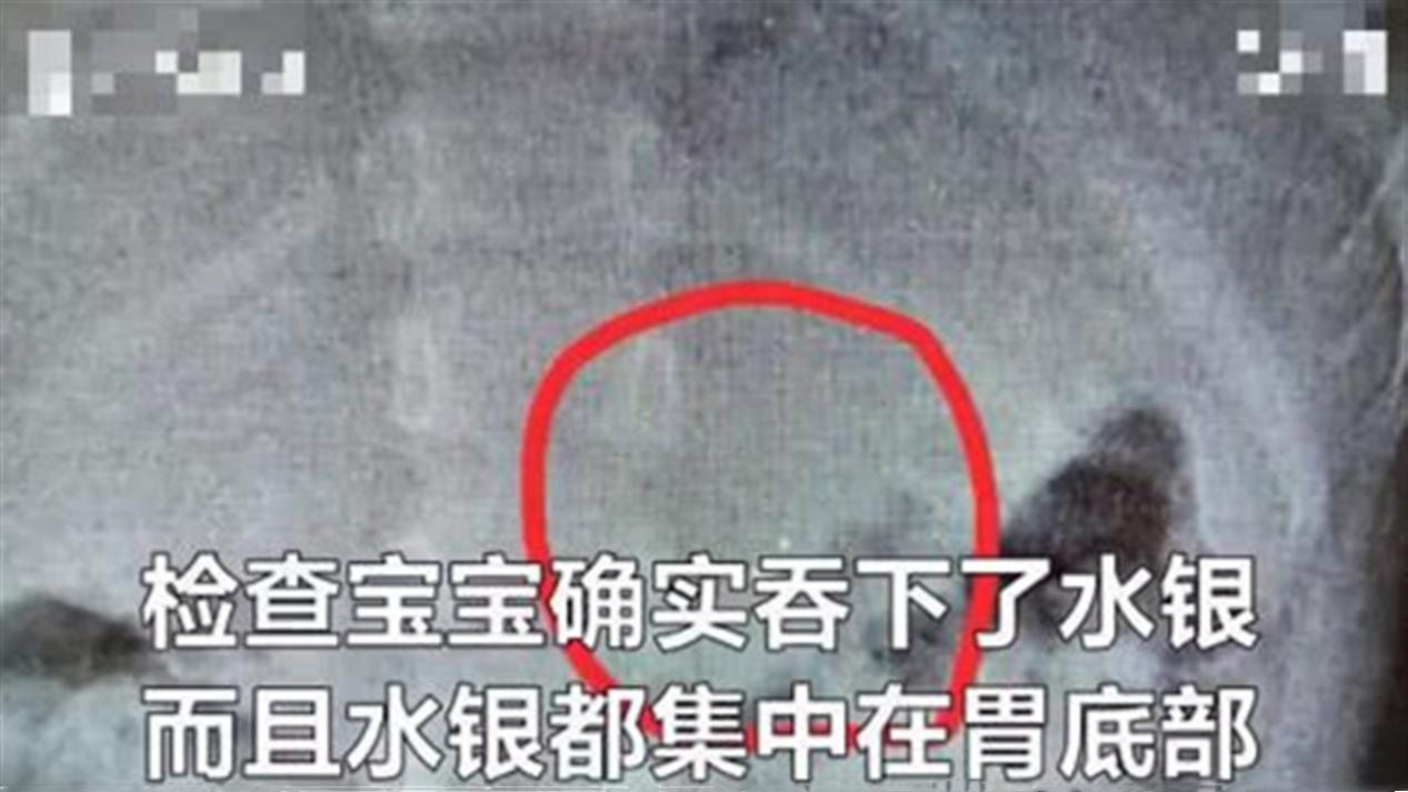 2岁男孩咬碎体温计后误吞水银,男童咬破体温计吞下水银