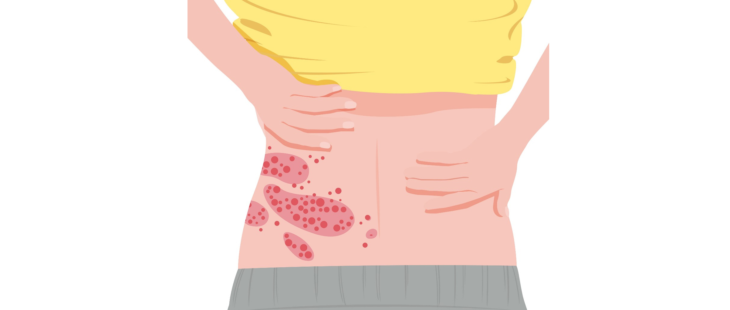 带状疱疹的几个误区,一生会得几次带状疱疹