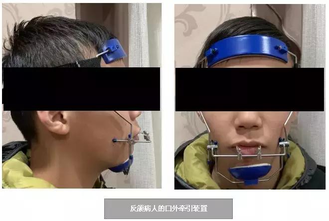 长期口呼吸的人是不是很没出息,长期口呼吸让人变丑