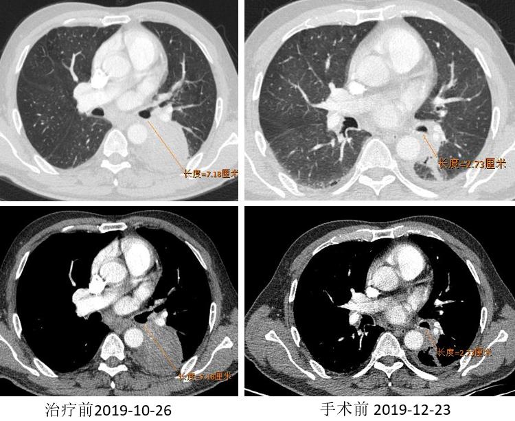 PD-1新辅助治疗初探，典型案例汇总一览