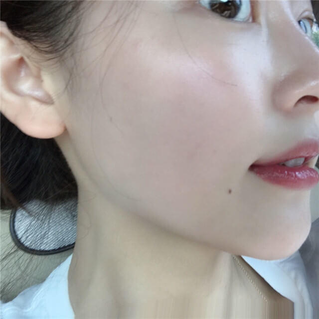 脸上出油严重毛孔粗大怎么办,毛孔爱出油毛孔粗大