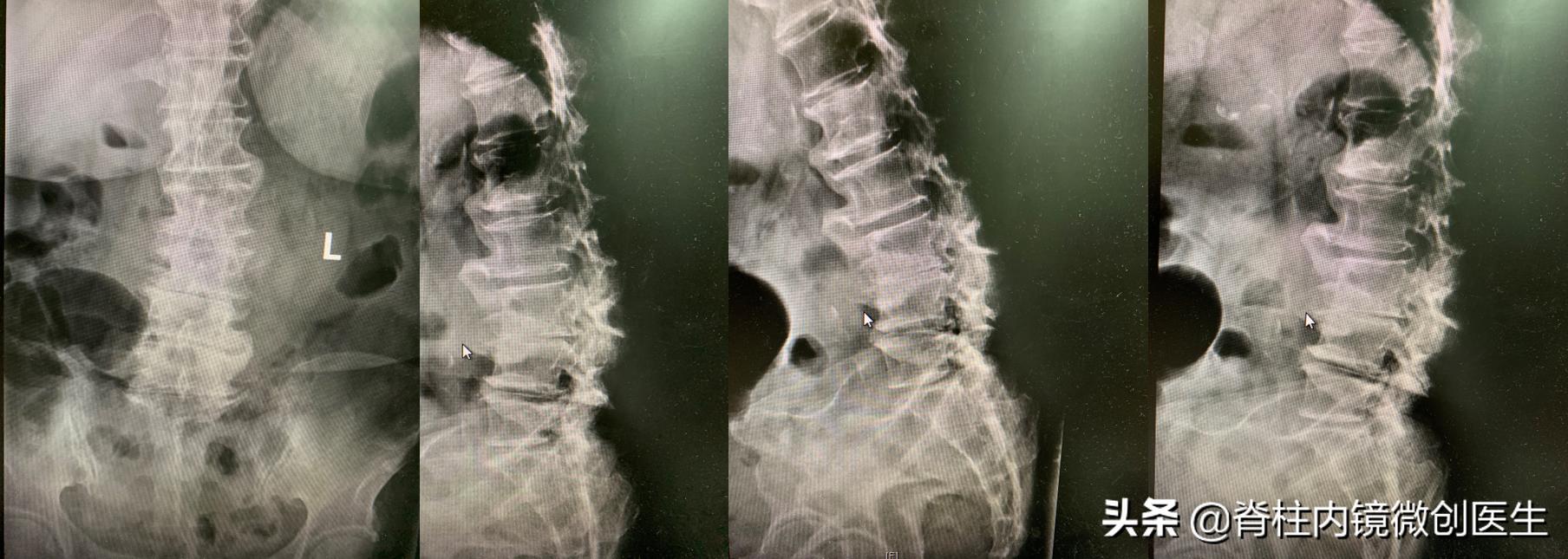 老年腰椎管狭窄的手术治疗,微创手术治疗腰椎管狭窄的技术