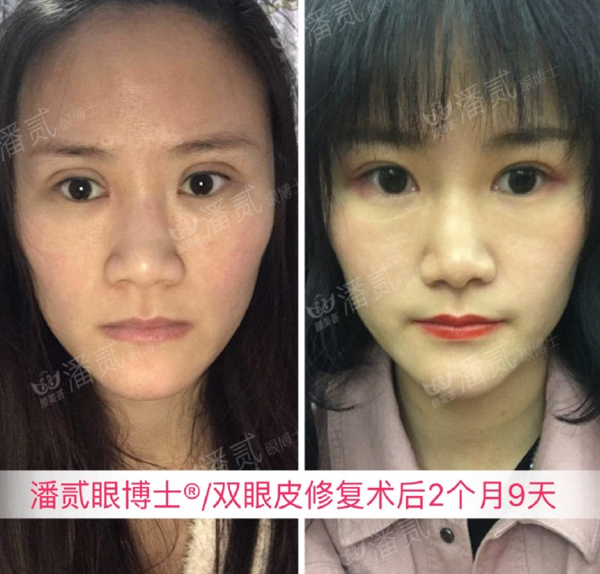 上海马大哈姑娘，稀里糊涂整了容，术后就一个字：丑