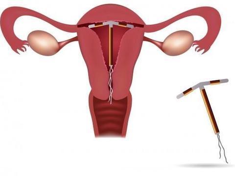 生完孩子一定要上环有什么好处,生完孩子以后上环是正确的吗