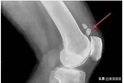 魏则西细胞疗法,魏则西滑膜肉瘤原发部位在哪