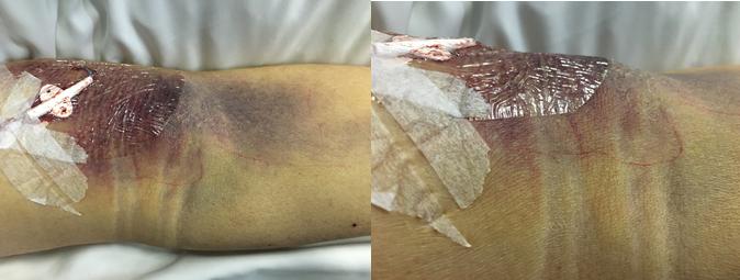 动脉穿刺后发生皮下血肿的原因,动脉穿刺失败怎么预防血肿