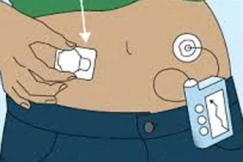 脆性糖尿病用什么药最好,脆性糖尿病中医如何治疗