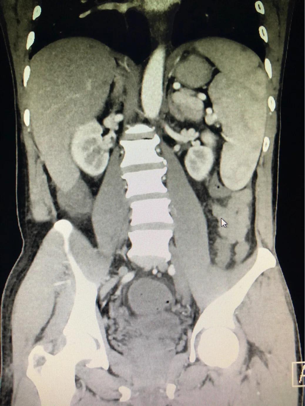 南方有黑热病,北京有黑热病么