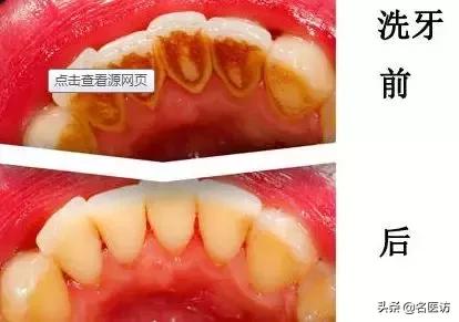 牙周炎才是牙齿松动的罪魁祸首,牙周炎导致全部牙齿脱落镶什么牙