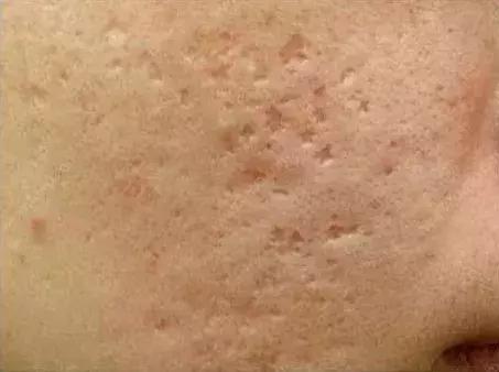 痘印祛痘药膏,痘印去除护肤品