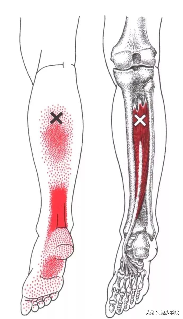 伤害了1/3跑者的胫骨炎，请务必重视起来
