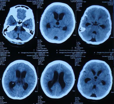 结核性脑积水,脑膜炎脑积水要治疗多久