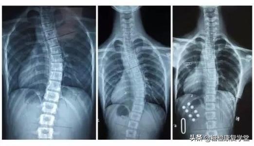 退行性脊柱侧凸的危害,退行性脊柱炎如何锻炼身体