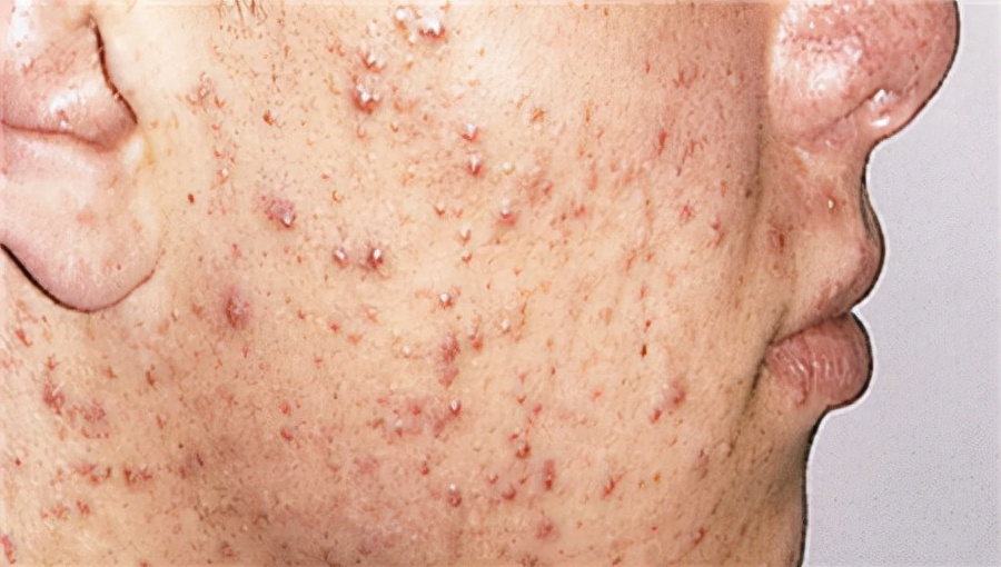 痘痘的周期一般是几天,痘痘的心酸史