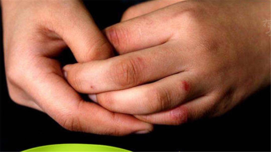 长冻疮吃什么食物,冬季全身寒冷有冻疮用什么药