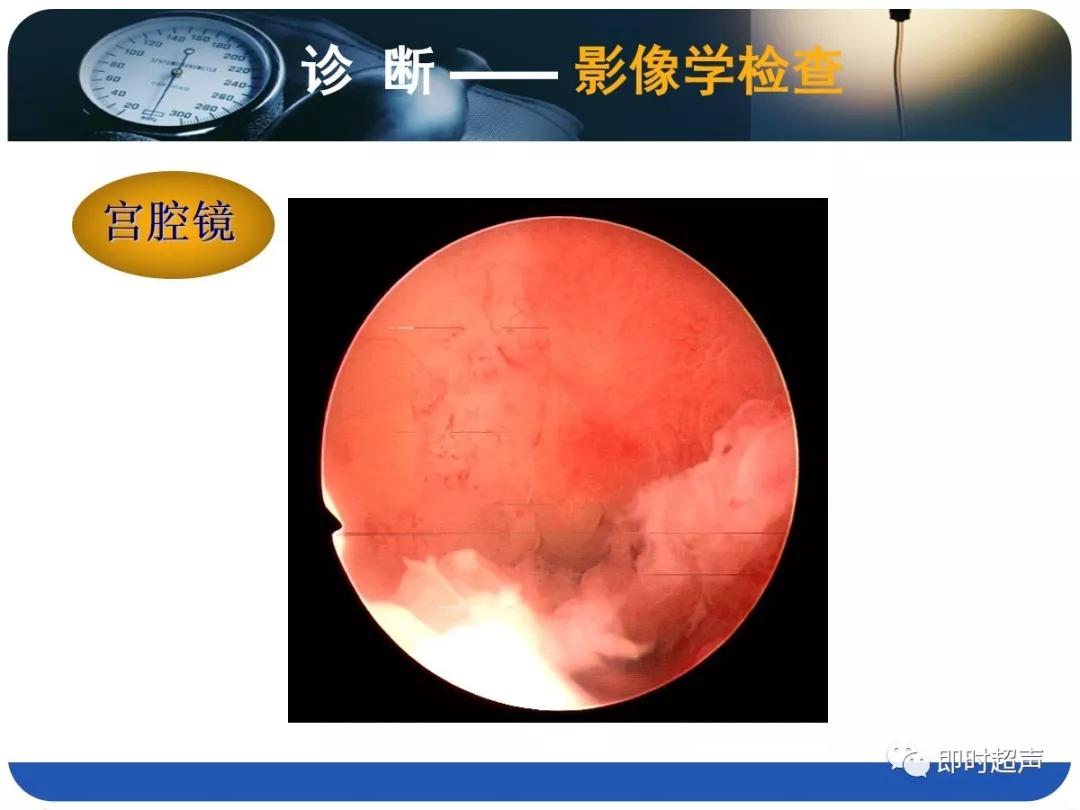 孕妇剖宫产瘢痕憩室,剖宫产瘢痕憩室息肉