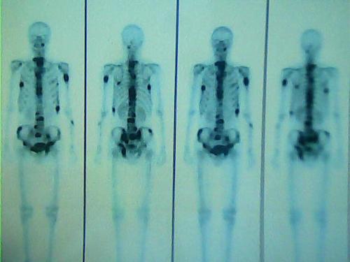 强化ct和ect哪个确诊肿瘤准确,ct与ect哪个危害大