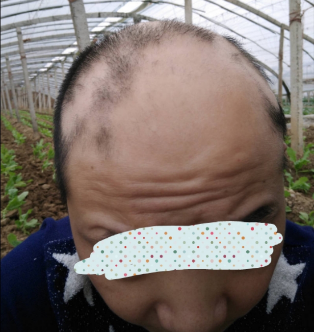 分享一些有什么解决脱发的方法吧,脱发分享