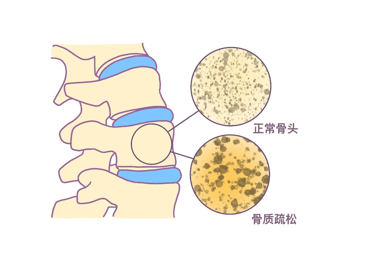骨关节炎该如何做好日常护理工作,骨关节炎天气变化有什么反应