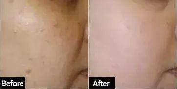 哪种果酸治闭口最好用,什么果酸对闭口有用